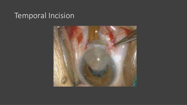 Small Incision Cataract Surgery Video Download